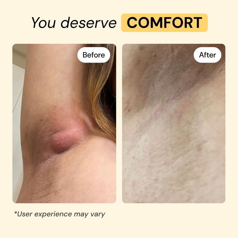 MyMagicHealer Universal Flare Care ?Multi-Purpose Solution | Skin Flare-Ups - Hidradenitis Suppurativa, Folliculitis, Boils, Cysts | Anti-Chafing | Irritated Skin Relief w/Propolis & Egg Yolk 1 oz